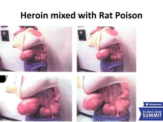 Heroin mixed with Rat Poison
 