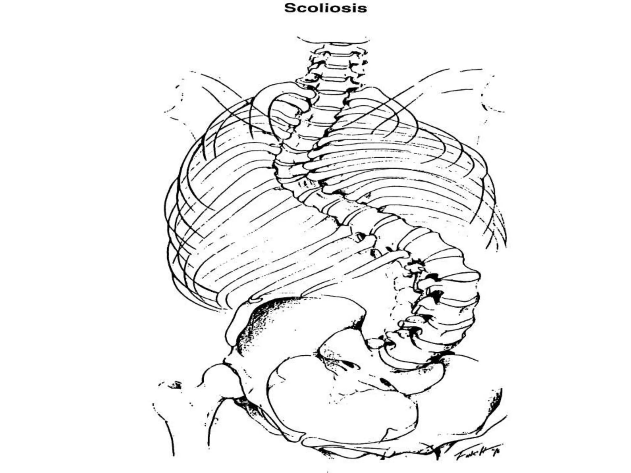 Score Riser scoliosis management and defination with treatment | PPT