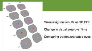 Visualizing trial results as 3D PDF
Change in visual area over time
Comparing treated/untreated eyes
 