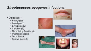 Streptococcus pyogenes Infections
• Diseases –
• Pharyngitis
• Impetigo (1)
• Erysipelas (2)
• Cellulitis (3)
• Necrotizing fascitis (4)
• Puerperal sepsis
• Toxic Shock
• Scarlet fever (5)
1
2
3
4
5
 