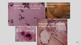 Branching Gram positive rods
of Actinomyces – antler like
Molar tooth colony on surface
of blood agar plate
Sulfur granule
Aggregates of Actinomyces
Cervicofacial actinomycoses
–lumpy jaw
 