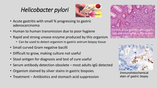Helicobacter pylori
• Acute gastritis with small % progressing to gastric
adenocarcinoma
• Human to human transmission due to poor hygiene
• Rapid and strong urease enzyme produced by this organism
• Can be used to detect organism in gastric antrum biopsy tissue
• Small curved Gram negative bacilli
• Difficult to grow, making culture not useful
• Stool antigen for diagnosis and test of cure useful
• Serum antibody detection obsolete – most adults IgG detected
• Organism stained by silver stains in gastric biopsies
• Treatment – Antibiotics and stomach acid suppression
Immunohistochemical
stain of gastric biopsy
Chronic active gastritis with plasma
cells and neutrophils in the lamina
propria. (H&E)
 