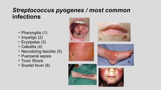 Streptococcus pyogenes / most common
infections
• Pharyngitis (1)
• Impetigo (2)
• Erysipelas (3)
• Cellulitis (4)
• Necrotizing fasciitis (5)
• Puerperal sepsis
• Toxic Shock
• Scarlet fever (6)
3
4
5
6
1 2
 
