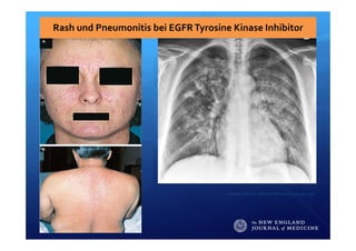Rash und Pneumonitis bei EGFR Tyrosine Kinase Inhibitor 
Cataldo VD et al. N Engl J Med 2011;364:947‐955.
 