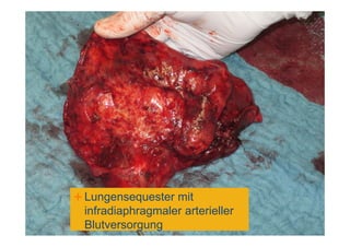 Lungensequester mit
infradiaphragmaler arterieller
Blutversorgung
 
