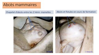 Abcès mammaires
Chapelet d’abcès entre les 2 hémi- mamelles Abcès et fistules en cours de formation