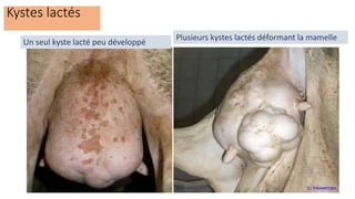 Kystes lactés
Un seul kyste lacté peu développé
Plusieurs kystes lactés déformant la mamelle