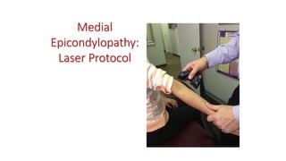 Medial
Epicondylopathy:
Laser Protocol
 