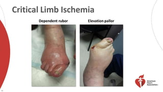 Critical Limb Ischemia
Dependent rubor Elevation pallor
46
 