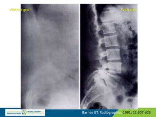 Barnes GT. Radiographics 1991; 11:307-323
Without grid With grid
 