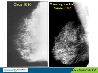 Courtesy Martin Yaffe, PhD
Mammogram from
Sweden 1981
 