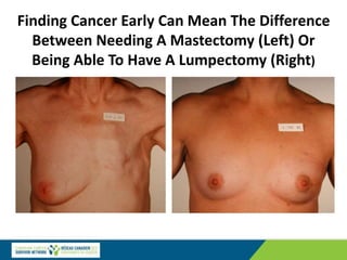 Finding Cancer Early Can Mean The Difference
Between Needing A Mastectomy (Left) Or
Being Able To Have A Lumpectomy (Right)
 