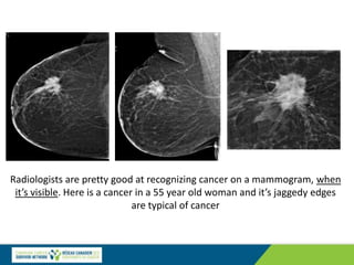 Radiologists are pretty good at recognizing cancer on a mammogram, when
it’s visible. Here is a cancer in a 55 year old woman and it’s jaggedy edges
are typical of cancer
 