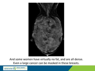And some women have virtually no fat, and are all dense.
Even a large cancer can be masked in these breasts.
 