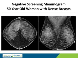 Negative Screening Mammogram
50 Year Old Woman with Dense Breasts
 