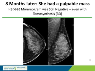 8 Months later: She had a palpable mass
Repeat Mammogram was Still Negative – even with
Tomosynthesis (3D)
63
 