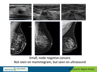 Small, node negative cancers
Not seen on mammogram, but seen on ultrasound
Courtesy Dr. Regina Hooley
 