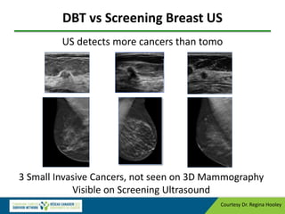 DBT vs Screening Breast US
US detects more cancers than tomo
3 Small Invasive Cancers, not seen on 3D Mammography
Visible on Screening Ultrasound
Courtesy Dr. Regina Hooley
 