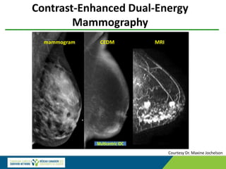 Courtesy Dr. Maxine Jochelson
Contrast-Enhanced Dual-Energy
Mammography
mammogram CEDM MRI
 