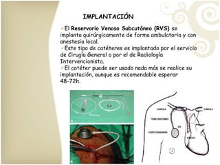 IMPLANTACIÓN El  Reservorio Venoso Subcutáneo (RVS)  se implanta quirúrgicamente de forma ambulatoria y con anestesia local. Este tipo de catéteres es implantado por el servicio de Cirugía General o por el de Radiología Intervencionista. El catéter puede ser usado nada más se realice su implantación, aunque es recomendable esperar 48-72h. 