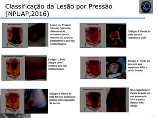 Classificação da Lesão por Pressão
(NPUAP,2016)
Lesão por Pressão
Tissular Profunda:
descoloração
vermelho escura,
marrom ou púrpura,
persistente e que não
embranquece.
Estágio 1: Pele
íntegra com
eritema que não
embranquece
Estágio 2: Perda da
pele em sua espessura
parcial com exposição
da derme
Estágio 3: Perda da
pele em sua
espessura total
Estágio 4: Perda da
pele em sua
espessura total e
perda tissular
Não Classificável:
Perda da pele em
sua espessura
total e perda
tissular não
visível.
 
