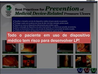 Todo o paciente em uso de dispositivo
médico tem risco para desenvolver LP!
 