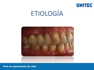 ETIOLOGÍA
 