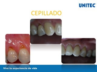 CEPILLADO
 