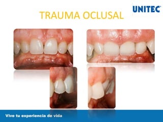 TRAUMA OCLUSAL
 