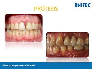 PRÓTESIS
 