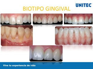 BIOTIPO GINGIVAL
 