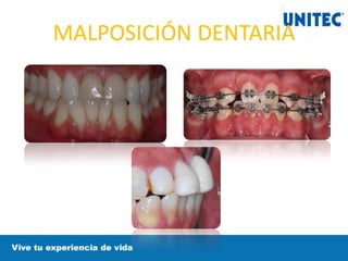 MALPOSICIÓN DENTARIA
 
