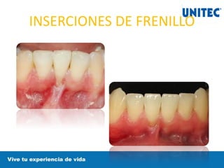 INSERCIONES DE FRENILLO
 