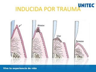 INDUCIDA POR TRAUMA
 