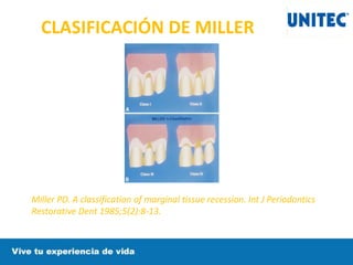 CLASIFICACIÓN DE MILLER
Miller PD. A classification of marginal tissue recession. Int J Periodontics
Restorative Dent 1985;5(2):8-13.
 