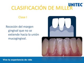 CLASIFICACIÓN DE MILLER
Clase I
Recesión del margen
gingival que no se
extiende hacia la unión
mucogingival.
 