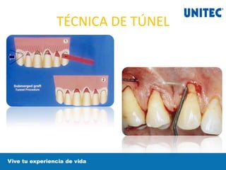 TÉCNICA DE TÚNEL
 