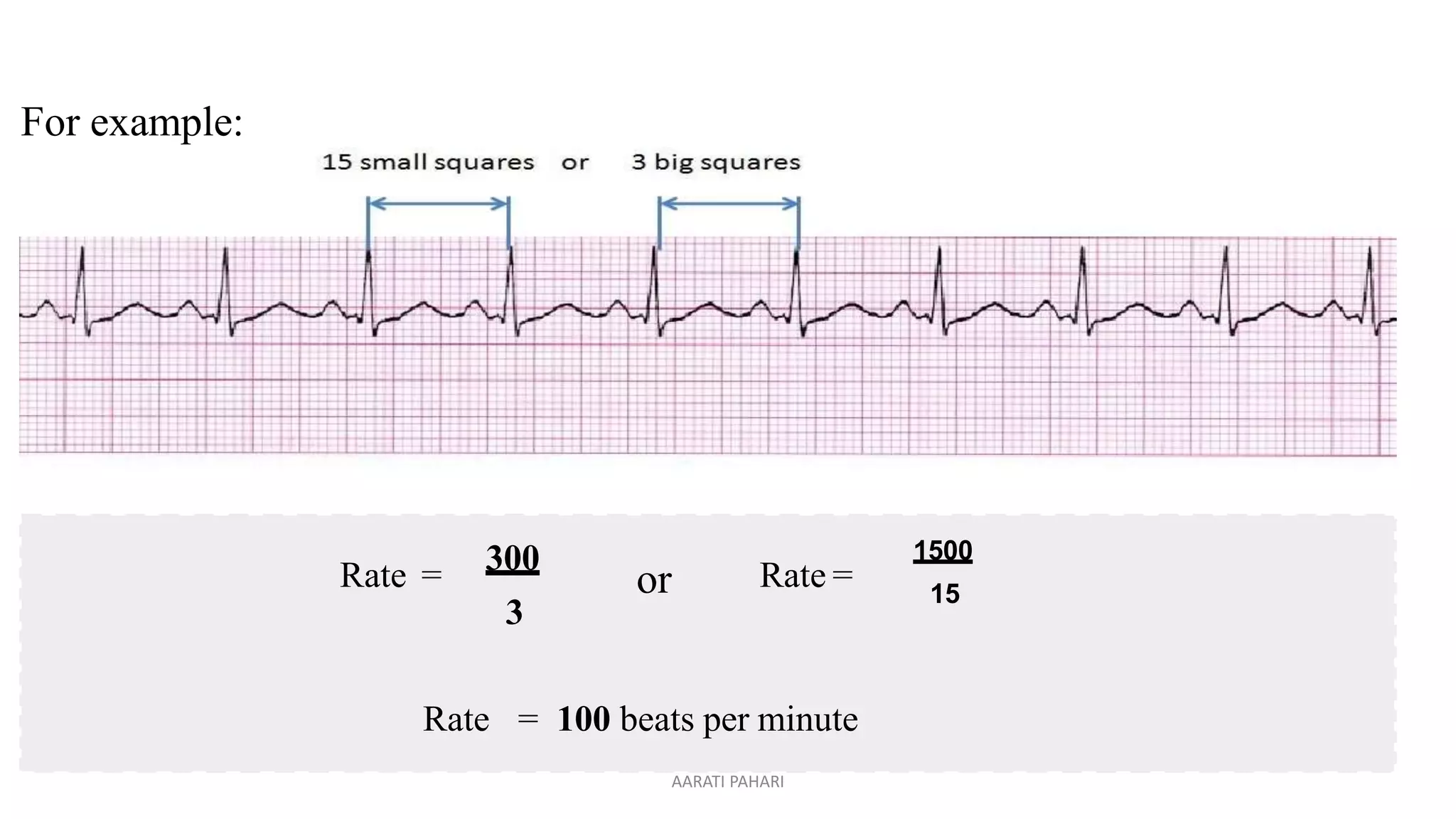 ECG AND ITS INTERPRETATION.pptx