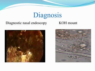 Diagnosis
Diagnostic nasal endoscopy KOH mount
 