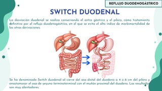 REFLUJO DUODENOGÁSTRICO (BILIAR) | PDF