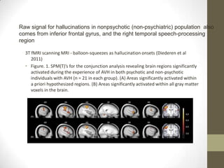 Raw signal for hallucinations in nonpsychotic (non-psychiatric) population also
comes from inferior frontal gyrus, and the right temporal speech-processing
region

  3T fMRI scanning MRI - balloon-squeezes as hallucination onsets (Diederen et al
     2011)
  • Figure. 1. SPM(T)’s for the conjunction analysis revealing brain regions significantly
     activated during the experience of AVH in both psychotic and non-psychotic
     individuals with AVH (n = 21 in each group). (A) Areas significantly activated within
     a priori hypothesized regions. (B) Areas significantly activated within all gray matter
     voxels in the brain.
 