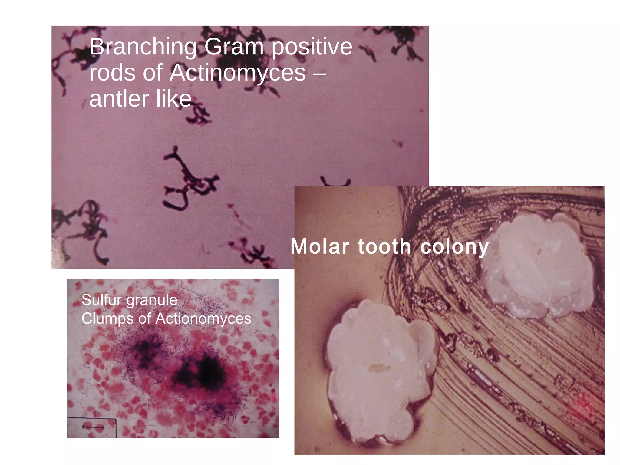 Branching Gram positive
rods of Actinomyces –
antler like
Molar tooth colony
Sulfur granule
Clumps of Actionomyces
 