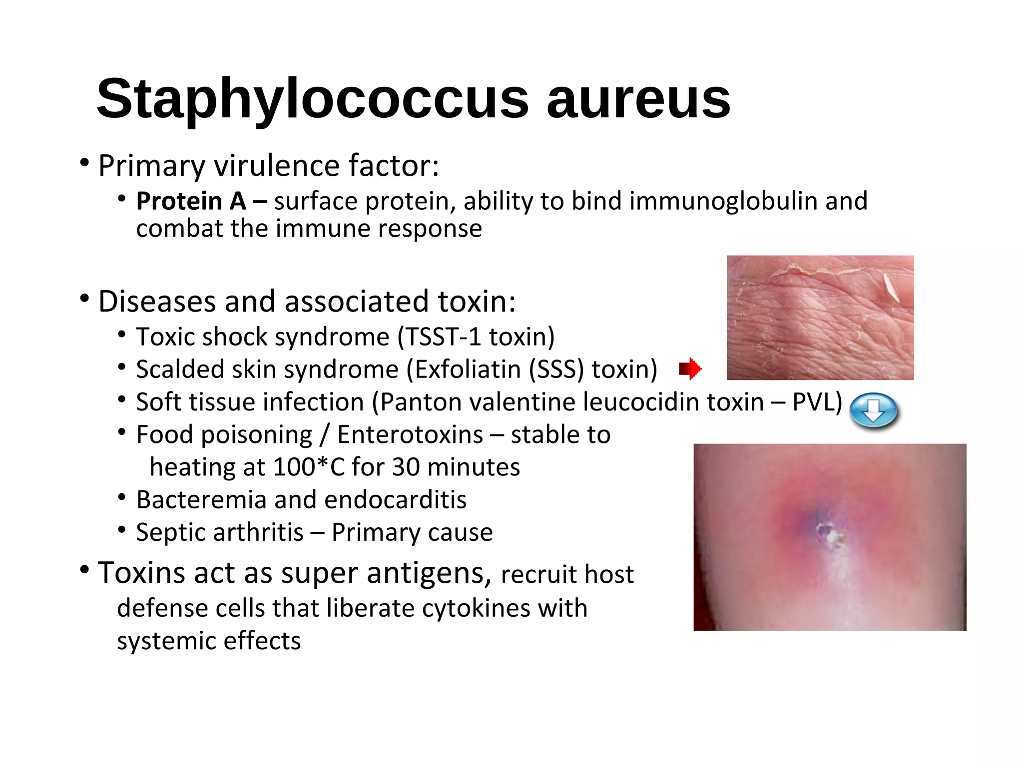 Staphylococcus aureus
• Primary virulence factor:
• Protein A – surface protein, ability to bind immunoglobulin and
combat the immune response
• Diseases and associated toxin:
• Toxic shock syndrome (TSST-1 toxin)
• Scalded skin syndrome (Exfoliatin (SSS) toxin)
• Soft tissue infection (Panton valentine leucocidin toxin – PVL)
• Food poisoning / Enterotoxins – stable to
heating at 100*C for 30 minutes
• Bacteremia and endocarditis
• Septic arthritis – Primary cause
• Toxins act as super antigens, recruit host
defense cells that liberate cytokines with
systemic effects
 