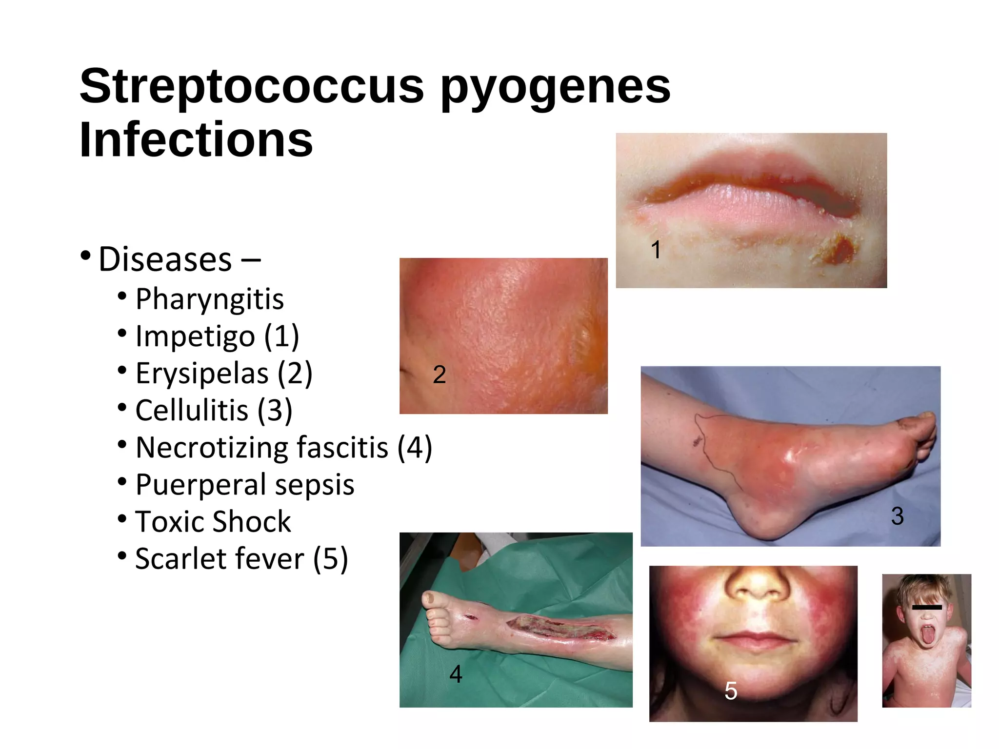 Streptococcus pyogenes
Infections
•Diseases –
• Pharyngitis
• Impetigo (1)
• Erysipelas (2)
• Cellulitis (3)
• Necrotizing fascitis (4)
• Puerperal sepsis
• Toxic Shock
• Scarlet fever (5)
1
2
3
4
5
 