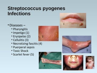 Streptococcus pyogenes
Infections
•Diseases –
• Pharyngitis
• Impetigo (1)
• Erysipelas (2)
• Cellulitis (3)
• Necrotizing fascitis (4)
• Puerperal sepsis
• Toxic Shock
• Scarlet fever (5)
1
2
3
4
5
 