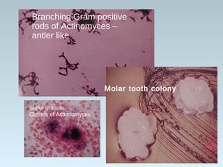 Branching Gram positive
rods of Actinomyces –
antler like
Molar tooth colony
Sulfur granule
Clumps of Actionomyces
 
