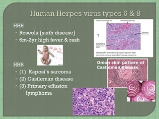  HH6
• Roseola [sixth disease]
• 6m-2yr high fever & rash
 HH8
• (1) Kaposi’s sarcoma
• (2) Castleman disease
• (3) Primary effusion
lymphoma
Onion skin pattern of
Castleman disease
1
1
1
2
3
 