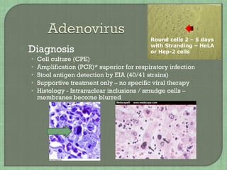 Diagnosis
• Cell culture (CPE)
• Amplification (PCR)* superior for respiratory infection
• Stool antigen detection by EIA (40/41 strains)
• Supportive treatment only – no specific viral therapy
• Histology - Intranuclear inclusions / smudge cells –
membranes become blurred
Round cells 2 – 5 days
with Stranding – HeLA
or Hep-2 cells
 