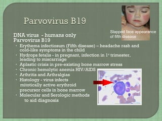  DNA virus - humans only
 Parvovirus B19
• Erythema infectiosum (Fifth disease) – headache rash and
cold-like symptoms in the child
• Hydrops fetalis - in pregnant, infection in 1st
trimester,
leading to miscarriage
• Aplastic crisis in pre-existing bone marrow stress
• Chronic hemolytic anemia HIV/AIDS
• Arthritis and Arthralgias
• Histology - virus infects
mitotically active erythroid
precursor cells in bone marrow
• Molecular and Serologic methods
to aid diagnosis
Slapped face appearance
of fifth disease
 