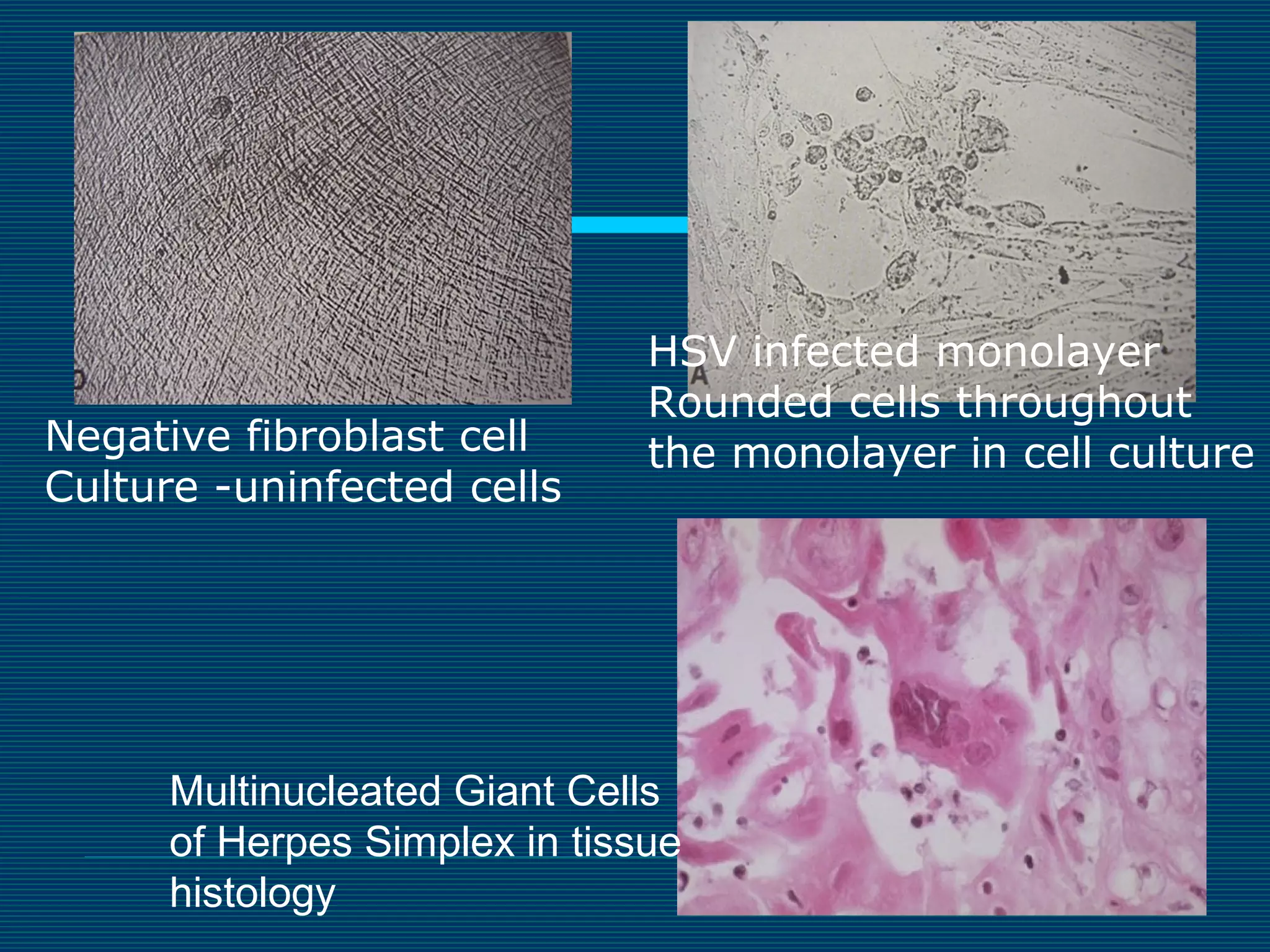 Negative fibroblast cell
Culture -uninfected cells

HSV infected monolayer
Rounded cells throughout
the monolayer in cell culture

Multinucleated Giant Cells
of Herpes Simplex in tissue
histology

 